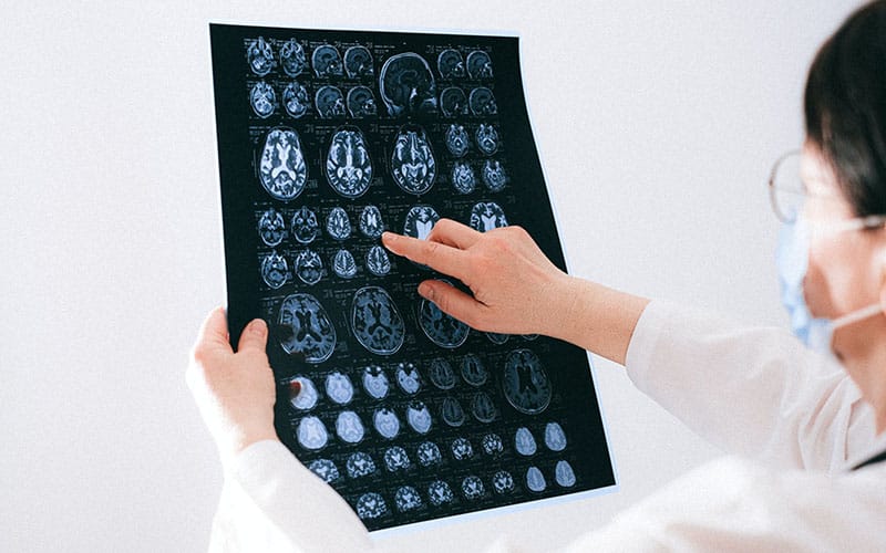 Epilepsy brain scan